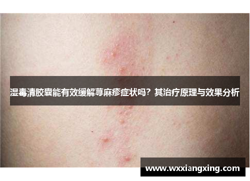 湿毒清胶囊能有效缓解荨麻疹症状吗？其治疗原理与效果分析